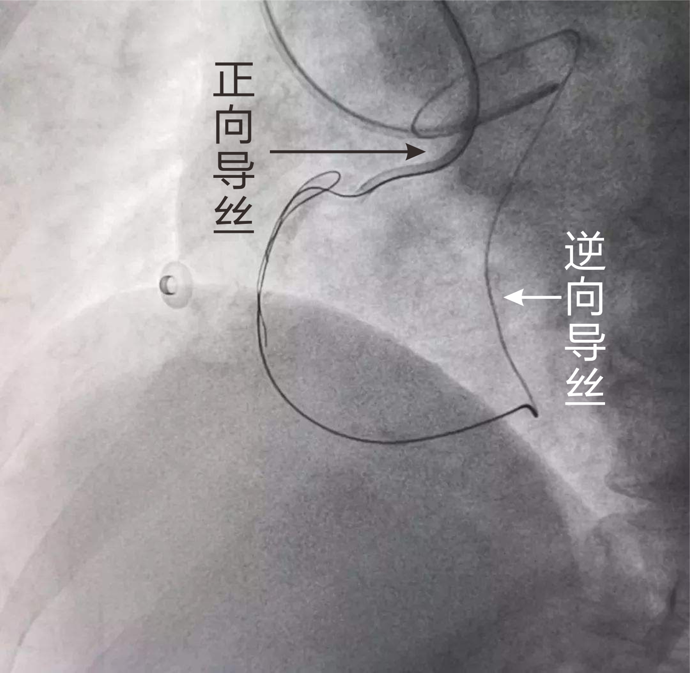 亚心医院成功应用逆向导丝技术治疗冠脉CTO病变(图2)